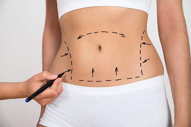 Liposuction in Riyadh