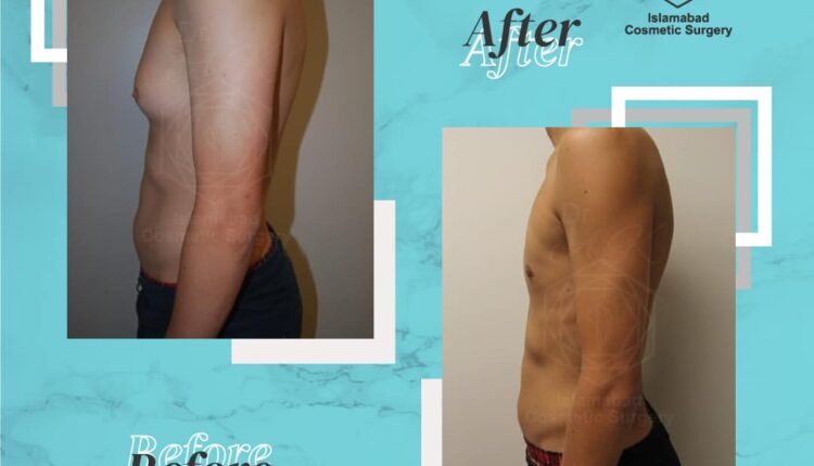 gynecomastia surgery cost in islamabad