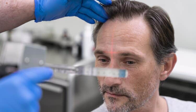 hårtransplantation