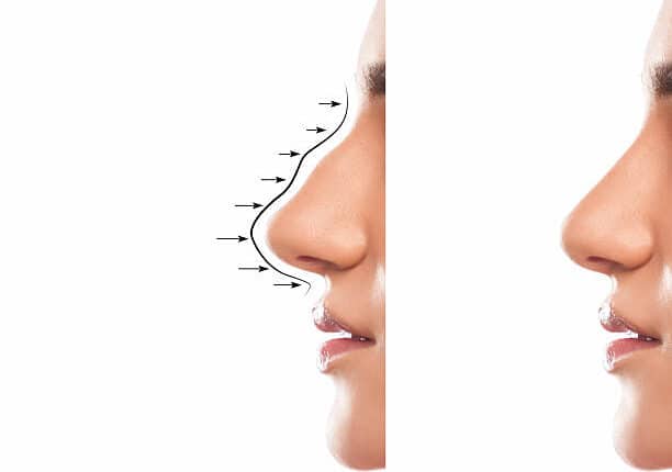 Hiko Nose Lift Cost in Riyadh