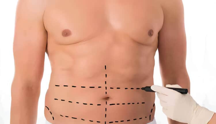 liposuction surgery in Islamabad