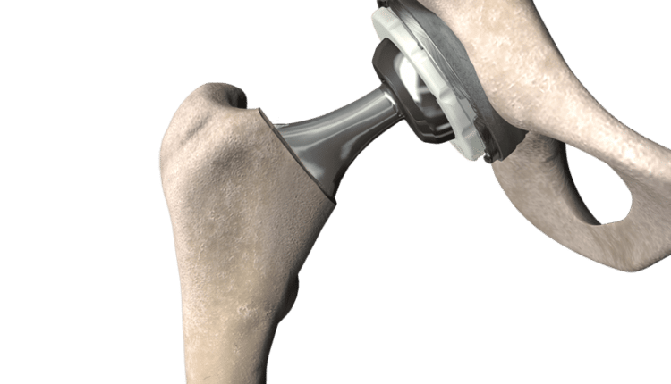 Best Hip Replacement Surgeon in Jaipur