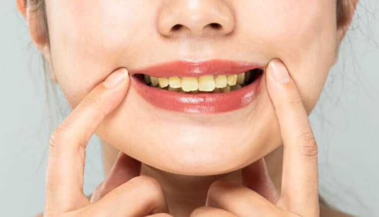 Why Are My Teeth Yellow When I Brush Them Every Day?