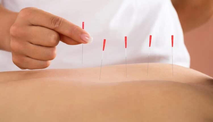 Dry Needling