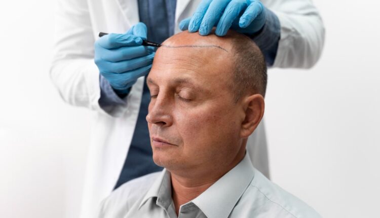 Hair Transplant in Islamabad