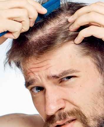 Hair Transplant in Riyadh