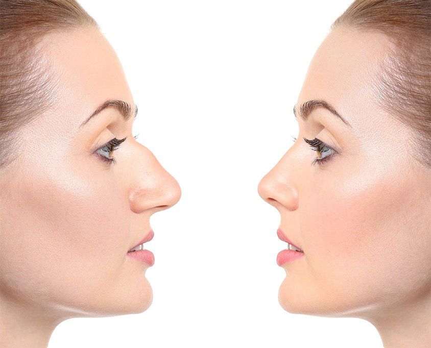 Rhinoplasty in Riyadh