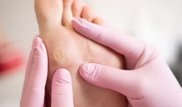 Callus Removal in Singapore