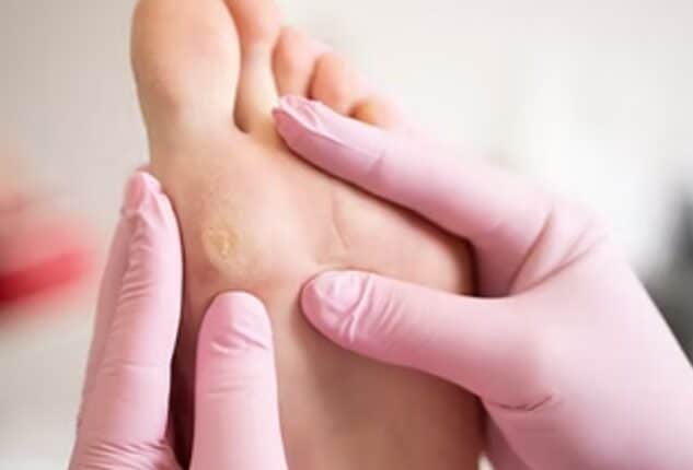 Callus Removal in Singapore