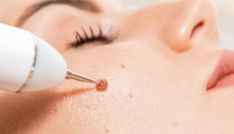 Warts Removal in Islamabad