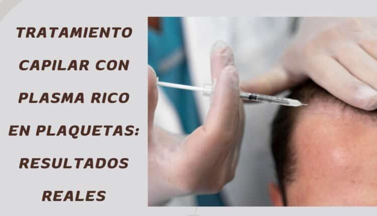 plasma rico en plaquetas cabello
