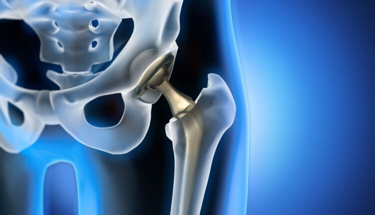 hip replacement last