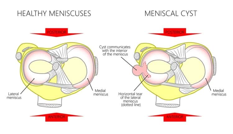 Meniscal Cyst