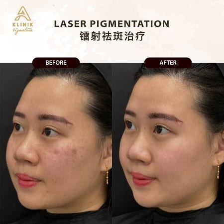 skin pigmentation facial treatment